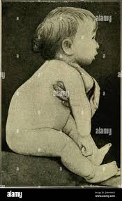 Image result for Craniotabes