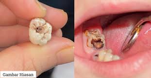 Kami menggunakan laser untuk meminimumkan pendarahan dan mempercepatkan proses pemutihan gigi serta proses. Tampal Segera Kalau Gigi Berlubang Elak Sampai Kena Buat Rawatan Root Canal Kos Cecah Rm1 000