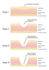 77 Accurate Wound Identification Dressing Selection Chart