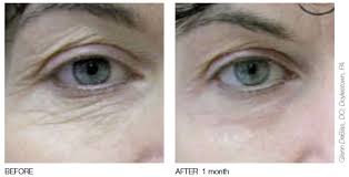 I had bikini laser hair removal treatment prior but still kept a landing strip, mostly because i was scared of the pain. Laser Hair Removal Laser Resurfacing Palo Alto Ca Redwood City Ca