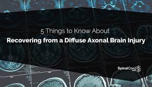 Image result for Diffuse Axonal Injury