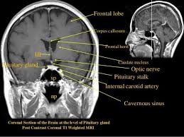 Mri Sectional Anatomy Of Brain Brain Anatomy Mri Brain Mri