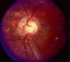 Image result for Coloboma