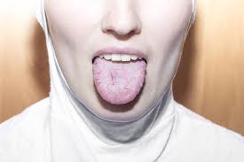 Maybe you would like to learn more about one of these? Glositis Radang Lidah Gejala Penyebab Cara Mengobati Hello Sehat