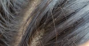 Image result for lice vs dandruff