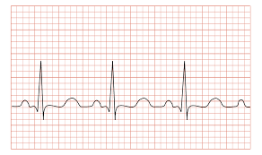 Bradycardia is a condition typically defined wherein an individual has a resting heart rate of under 60 beats per minute (bpm) in adults, although some studies use a heart rate of less than 50 bpm. Tachycardia Wikipedia