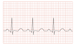 While the pr interval is normal, at.14 the inferior st segments are very flat, which is not normal, while the rest of the st segments display the normal concave up smile shape. Tachycardia Wikipedia