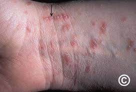Image result for scabies symptoms