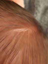 Image result for white scabs on the head in children