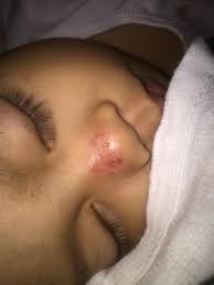 Image result for yellow scabs on the face in children