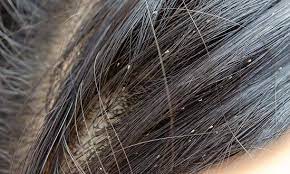 The main thing that attracts lice is the dirty hair you may attract for this parasitic insect. Head Lice Nits Children Teens Raising Children Network