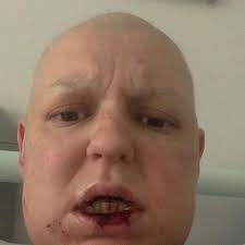 Fundraiser by jenna Hancock : Help Jen THRIVE healing from Rare cancer plus  amputation.