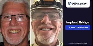 Implant Bridge vs. Dentures: Which Is the Better Option?