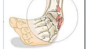 Pregunta acerca de tu tarea. Apa Itu Sprain Ankle Penyebab Dan Penanganan Cedera Engkel Tribun Jateng
