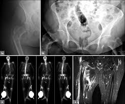 Muscle mri can detect abnormal muscle volume, abnormal muscle signal (fatty infiltration or edema), mass lesion, and abnormal anatomy. A 63 Year Old Woman With Acute Thigh Pain In The Setting Of Subacute Back Thigh Pain