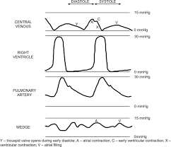 Image result for Collapsing Pulse