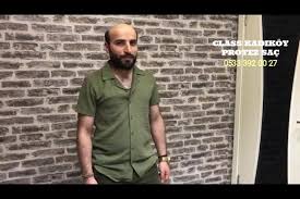 Kadikoy Protez Sac Kadikoy Protez Sac Ve Protez Sac Bakimi Merkezi Facebook