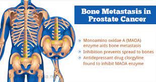 Many men experience bone related problems as a result of prostate cancer or its treatment. Health Tip On New Method That Prevents Bone Metastasis In Prostate Cancer Patients