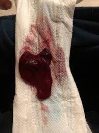 We did not find results for: What Does A Miscarriage Blood Clot Look Like At 5 Weeks