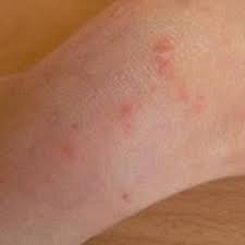 How To Get Rid Of Scabies 11 Natural Ways Scabies Scabies Treatment Home Remedies