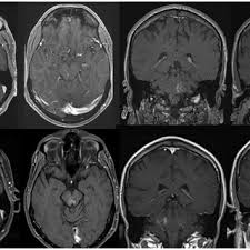 Clinical significance, diagnostic criteria, and principles of tratment. Pdf Chronic Lymphocytic Inflammation With Pontine Perivascular Enhancement Responsive To Steroids Clippers