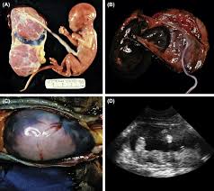 This condition occurs when the placenta is located at the bottom of the uterus, blocking the opening of the cervix. Solutio Placentae An Overview Sciencedirect Topics