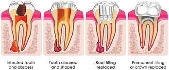 A tooth consists of a crown and roots. A Cap Or No Cap After Root Canal Treatment