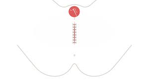 Entdecke rezepte, einrichtungsideen, stilinterpretationen und andere ideen zum ausprobieren. Sunat Perempuan Praktik Yang Masih Sering Terjadi Saya Menjerit Kesakitan Bbc Tempo Co