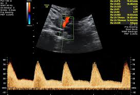 Feinultraschall ist die sonografische untersuchung im rahmen der pränataldiagnostik, also eine untersuchung des ungeborenen kindes, mittels eines besonders hochauflösenden ultraschallgerätes. Ersttrimester Ultraschall Fruhe Feindiagnostik Nackenfaltenmessung Praxis Fur Pranatale Diagnostik