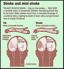 Recovering From A Stroke Transient Ischemic Attack Nurse Medical