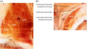 Other articles where lenticular nucleus is discussed: Whole Course Of Pallidothalamic Tracts Identified On The Sectioned Images And Surface Models Chung 2020 Clinical Anatomy Wiley Online Library