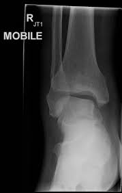 Image result for Ankle Dislocation