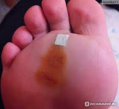 как вывести сухой мозоль со стержнем на пальце ноги Plastyr Verofarm Salipod Ot Mozolej Udalenie Sterzhnevoj Mozoli Plastyrem Salipod Otzyvy Pokupatelej