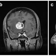 Preoperative study. The initial radiological diagnosis was a right...