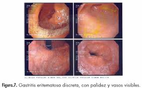 Resultado de imagen para gastritis helicobacter pylori