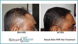 Posted on january 7, 2021 february 24, 2021. Prp Treatment For Hair Loss Side Effect Success Rate Cost And Results
