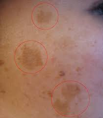 Estas incluyen productos tópicos (cremas), peelings y otros. Melasma Wikipedia