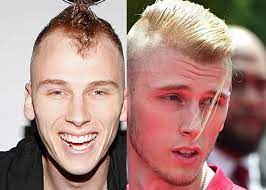 Machine Gun Kelly Hair Transplant Hair Analysis By Matt Dominance
