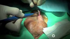 Abbiamo già visto che, dal punto di. Vasectomia Medicina E Youtube