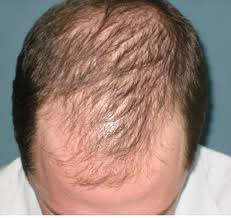 Our hair and scalp absorbs everything we put on it. Hair Loss Thinning Hair Shampoo Sulfates Could Be The Culprit Susy Sayz