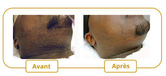 Every time you have a laser hair removal treatment, a beam of light is aimed at the hair. Hair Removal For Pigmented Skin Medime Institut De Medecine Esthetique De Montreal