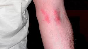 Sep 12, 2018 · if you think you might have come into contact with poison sumac, rinse the area with lots of cool water and dish soap or rubbing alcohol as soon as possible. Poison Sumac Rash Pictures And Treatment