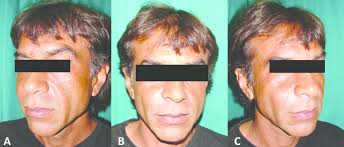 Clinical aspect of patient in right oblique view (A), frontal view (B)...