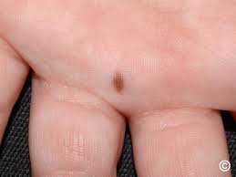 Image result for Acral lentiginous melanoma nail