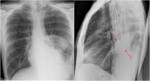 Pleural effusion refers to a buildup of fluid in the space between the lungs and the chest cavity. Epos Trade