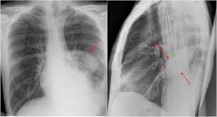 It can result from pneumonia and many other conditions. Epos Trade