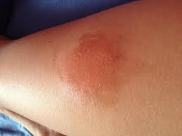 Grosser Muckenstich Muss Ich Zum Arzt Haut Insektenstich