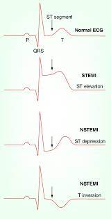 In contrast to a type 1 mi (stemi and nstemi), at type 2 mi results from an imbalance between myocardial oxygen supply and demand unrelated to acute coronary artery thrombosis or plaque rupture. Schematic Representations Of Ecg Patterns Normal Ecg Pattern With Download Scientific Diagram