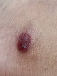 Image result for spinne biss haut reaktion