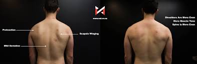 How long does it take to get sick? Winged Scapula And Shoulder Pain Case Study Oni Wellington Personal Training Studio